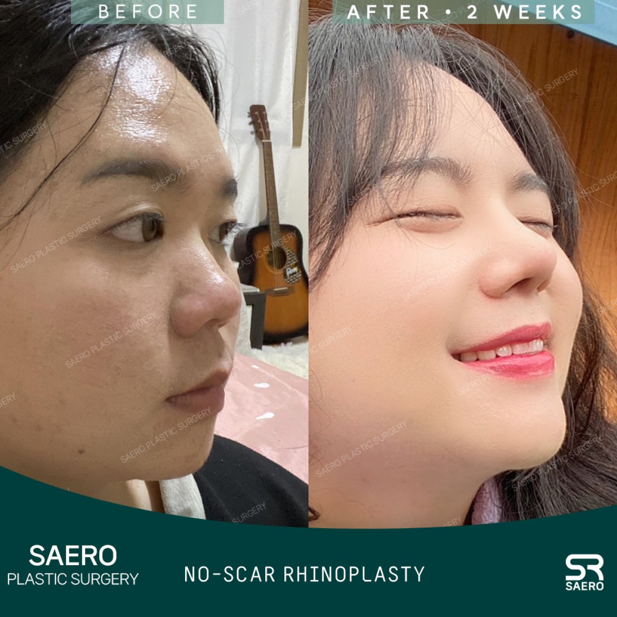 نتائج قبل وبعد عملية تجميل الأنف المغلقة في SAERO Plastic Surgery بدون ندوب ظاهرة