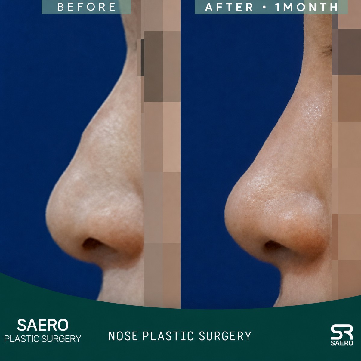 Before and after closed rhinoplasty results at SAERO Plastic Surgery, improved nose profile