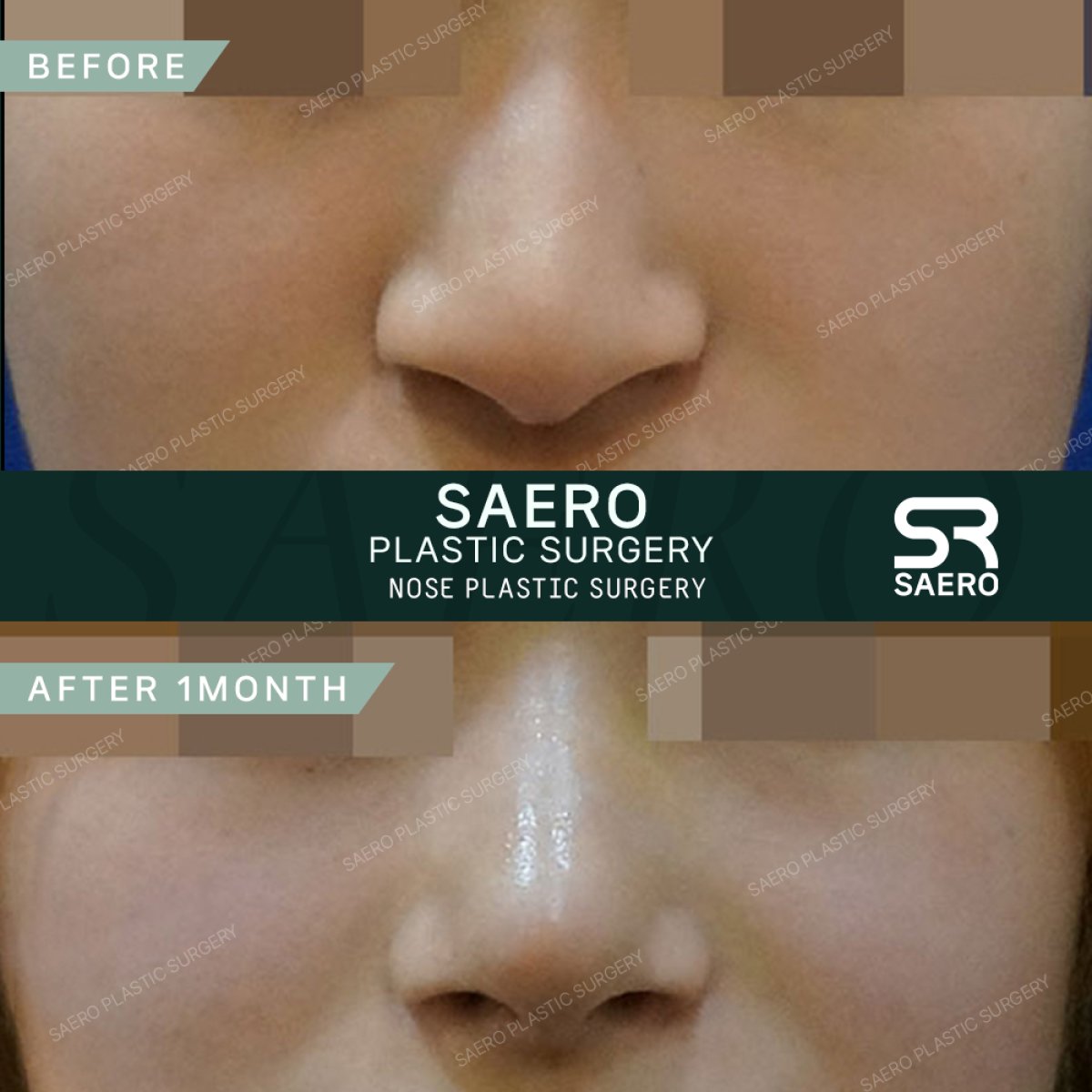 نتائج قبل وبعد عملية تجميل الأنف المغلقة في SAERO Plastic Surgery، تحسين شكل الأنف