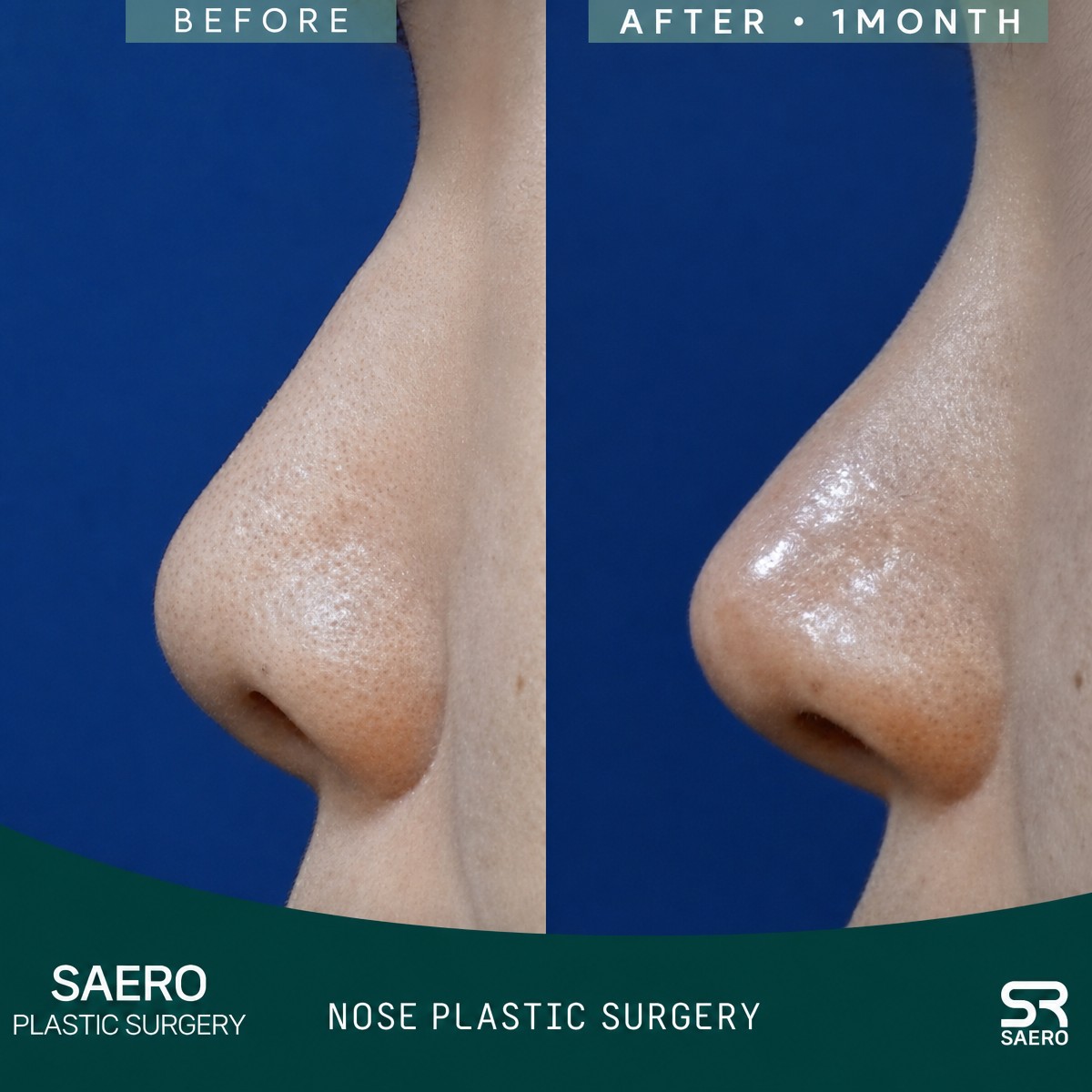 Результаты до и после закрытой ринопластики в SAERO Plastic Surgery, улучшенный профиль носа