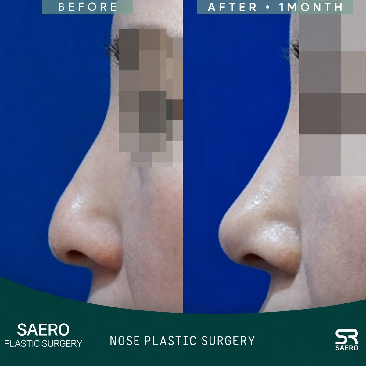 Efekty przed i po zamkniętej korekcji nosa w SAERO Plastic Surgery, poprawiony profil nosa