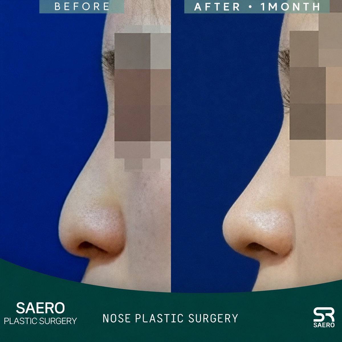 Closed rhinoplasty before and after results at SAERO Plastic Surgery, improved nose profile