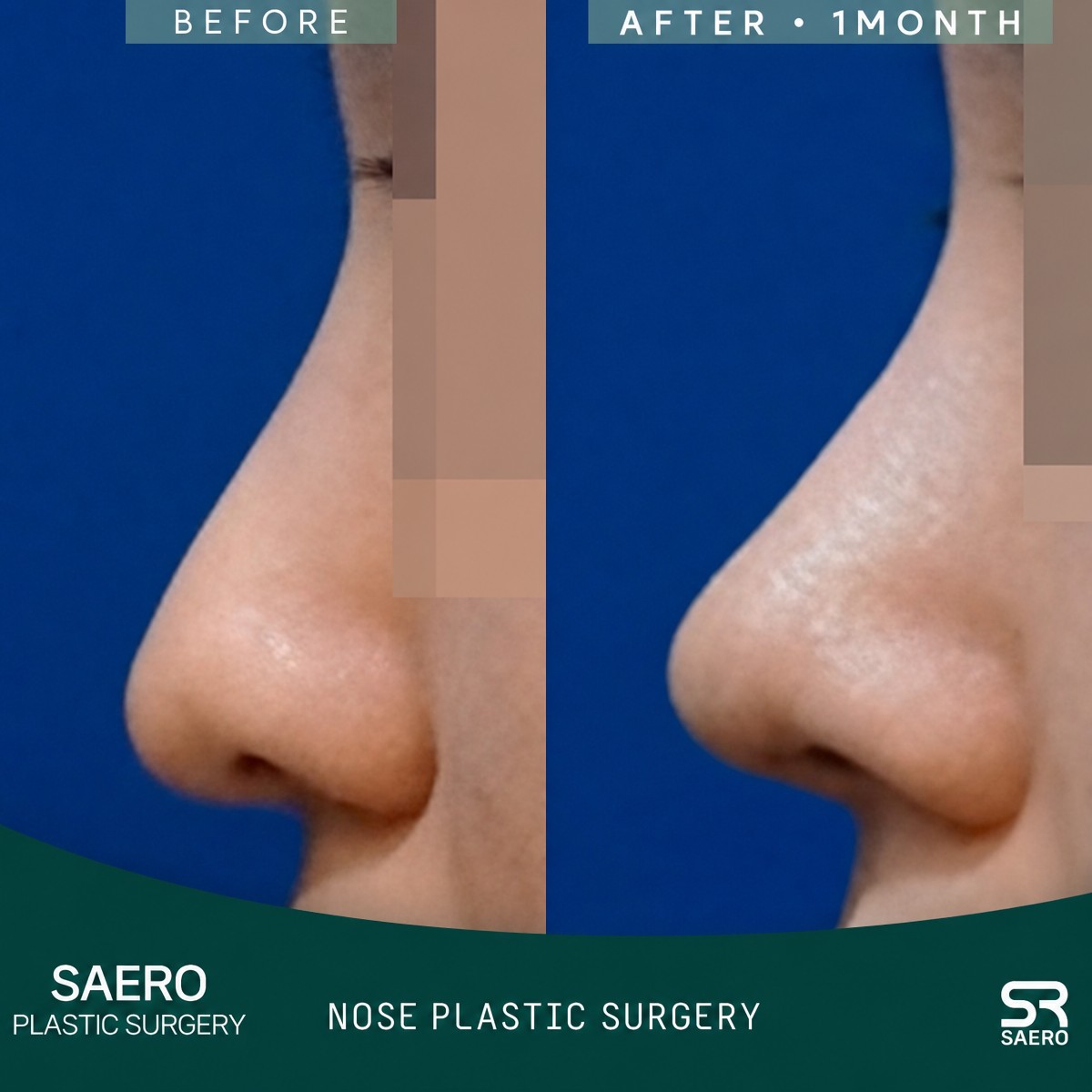 Closed rhinoplasty before and after results at SAERO Plastic Surgery, improved nose profile
