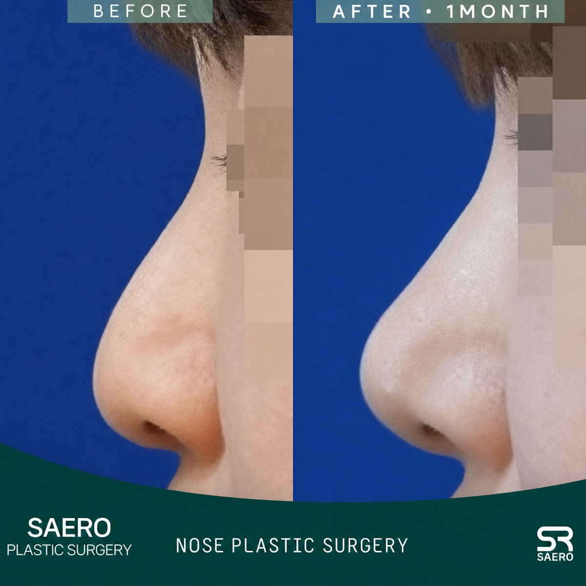 Before and after closed rhinoplasty result at SAERO Plastic Surgery, improved nose profile