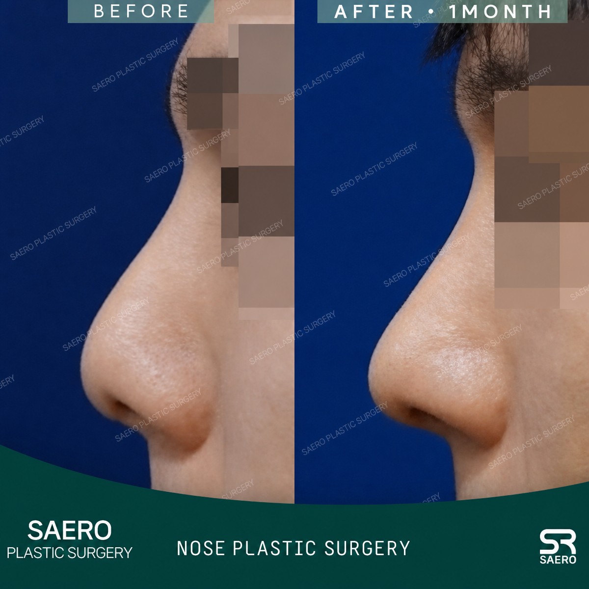 Closed rhinoplasty before and after results at SAERO Plastic Surgery, improved nose profile