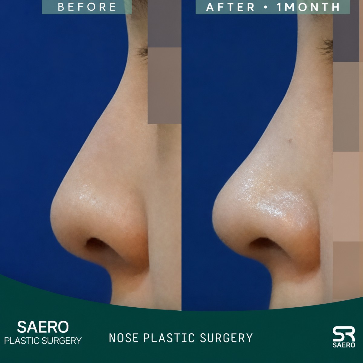 نتائج تجميل الأنف المغلق قبل وبعد في SAERO Plastic Surgery، تحسين شكل الأنف