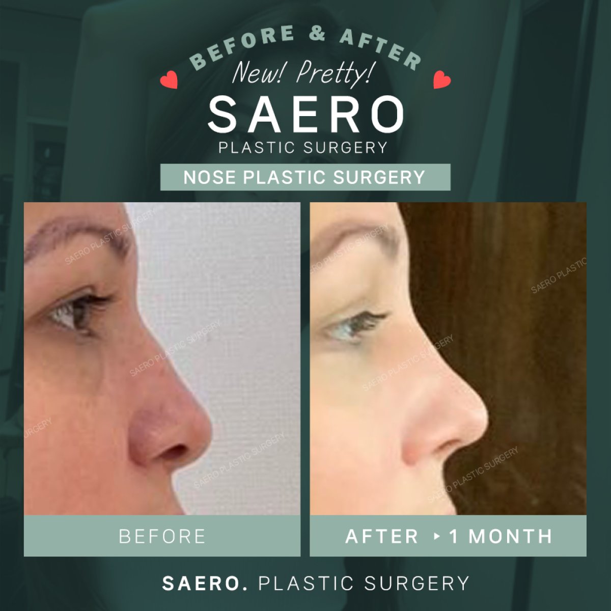 نتائج تجميل الأنف بالأوستيوتومي قبل وبعد في SAERO Plastic Surgery، تحسين شكل الأنف