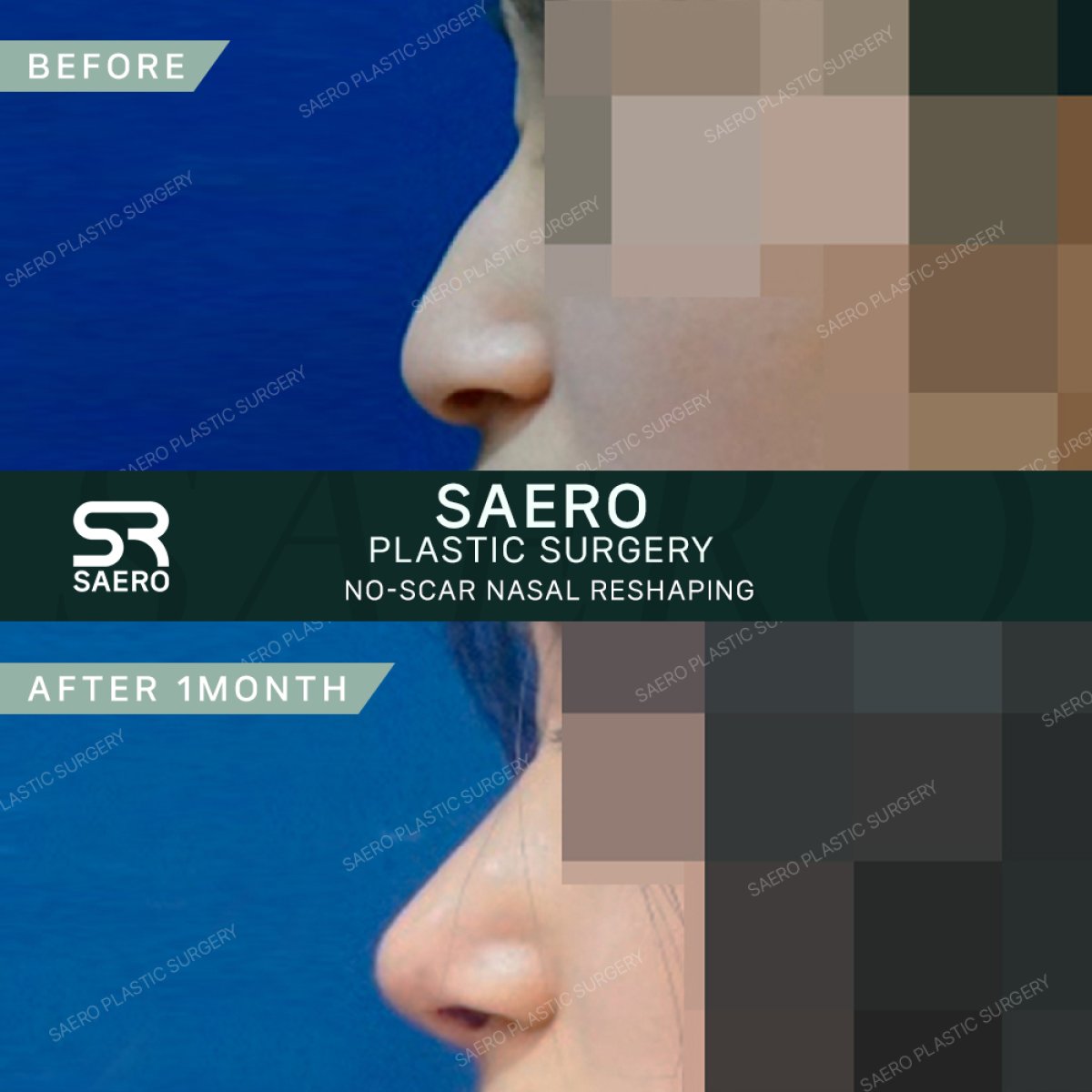 Efekty osteotomii nosa przed i po w SAERO Plastic Surgery, korekta kształtu nosa