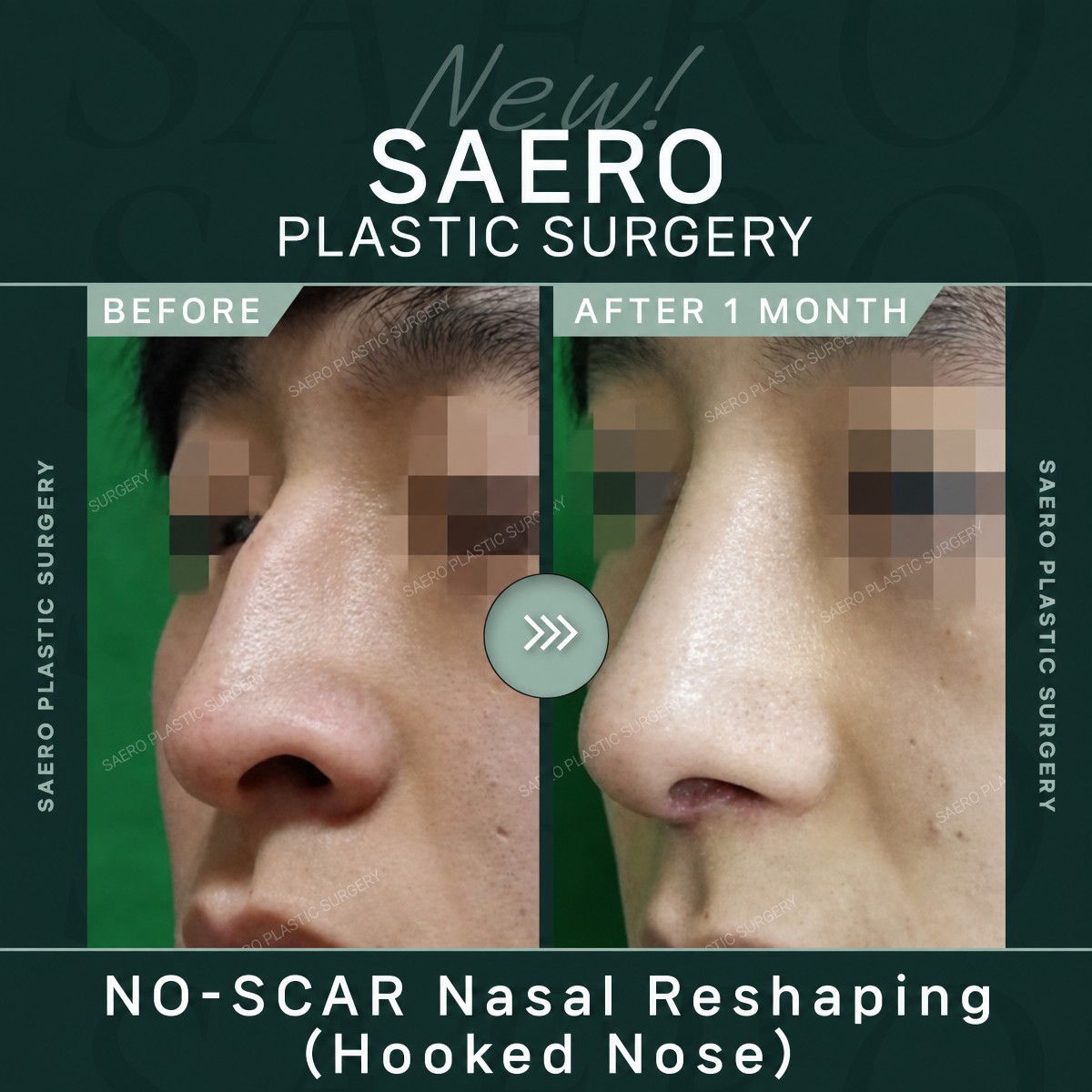 نتائج تجميل الأنف بدون ندوب للأنف المعقوف في SAERO Plastic Surgery