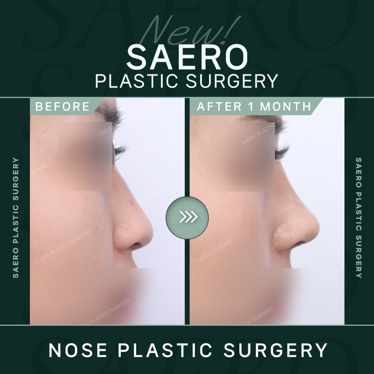 نتائج تجميل الأنف بالأوستيوتومي قبل وبعد في SAERO Plastic Surgery، إعادة تشكيل الأنف