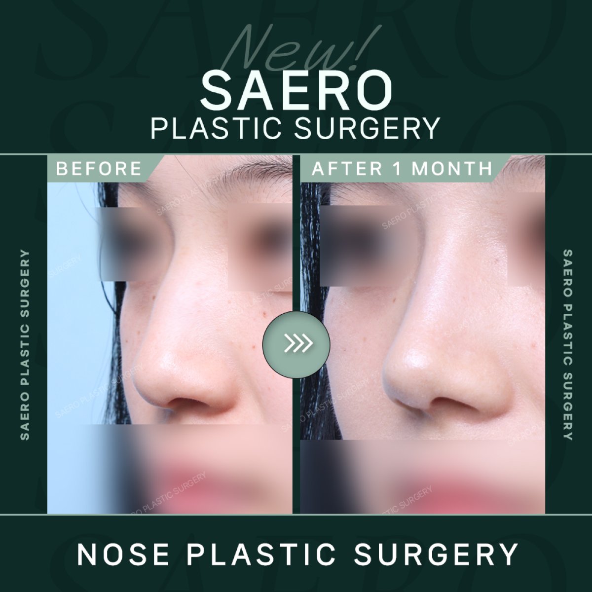 Before and after osteotomy rhinoplasty results at SAERO Plastic Surgery, improved nose shape