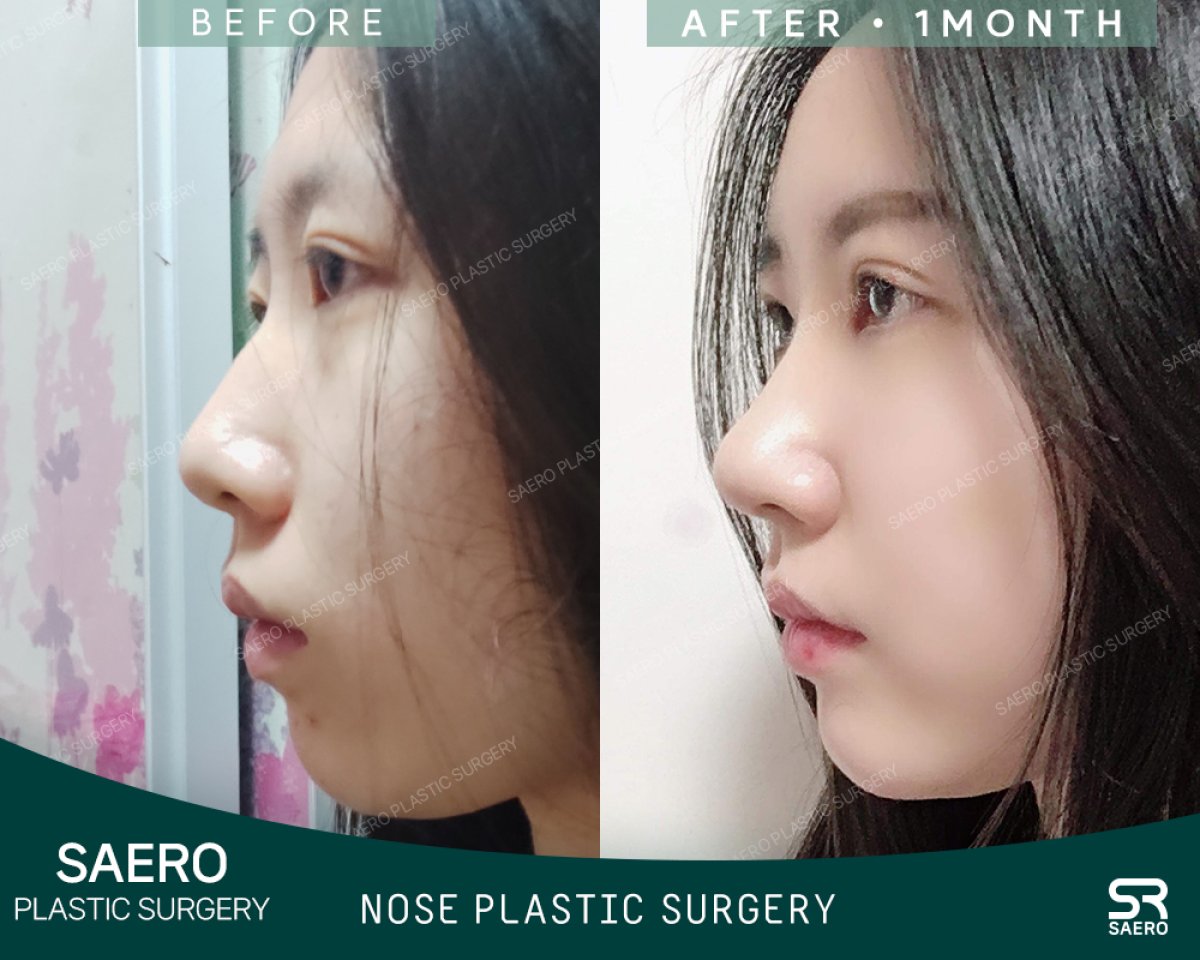 نتائج رأب الأنف بالأوستيوتومي قبل وبعد في SAERO Plastic Surgery، تحسين شكل الأنف