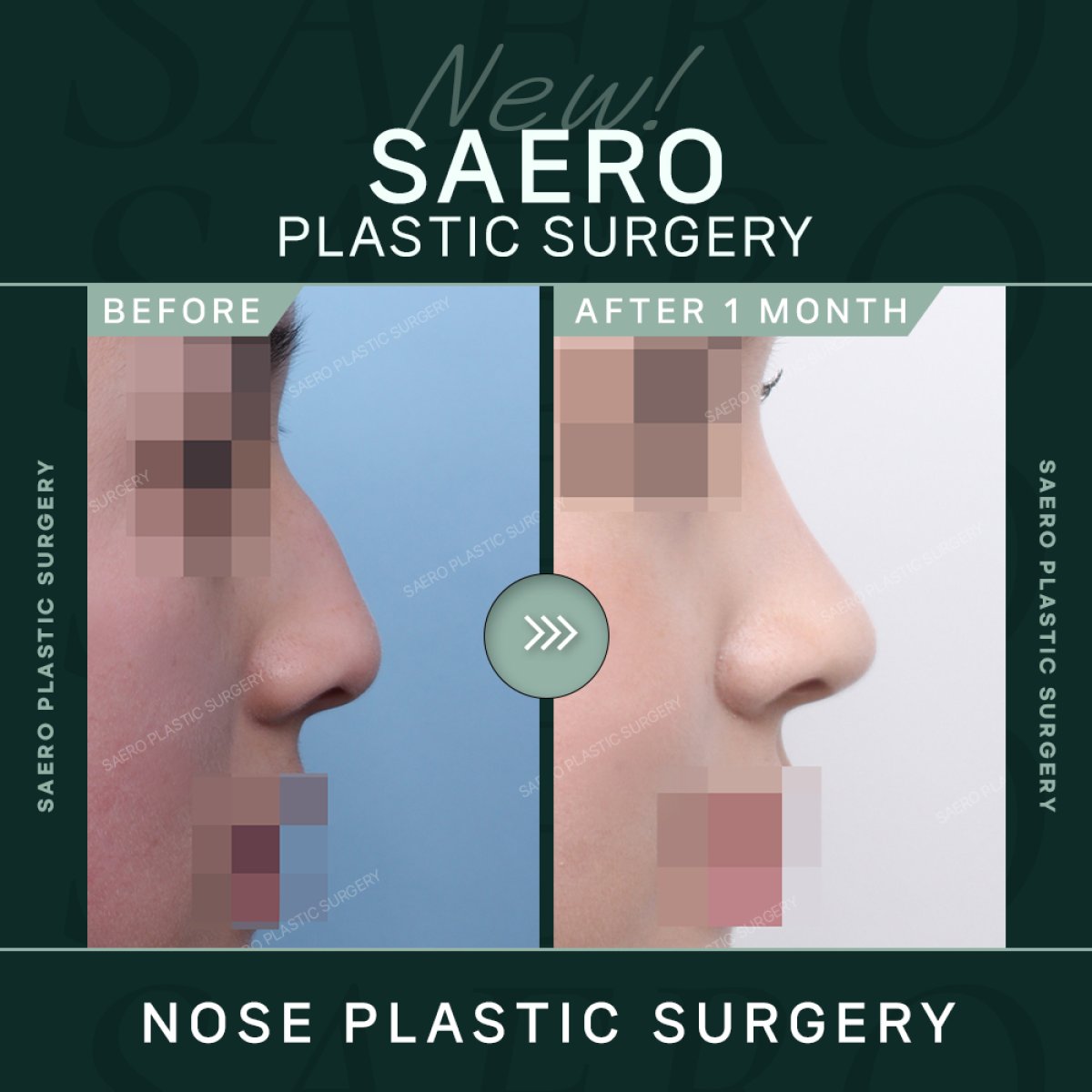 Результаты остеотомии ринопластики до и после в SAERO Plastic Surgery, улучшенный профиль носа