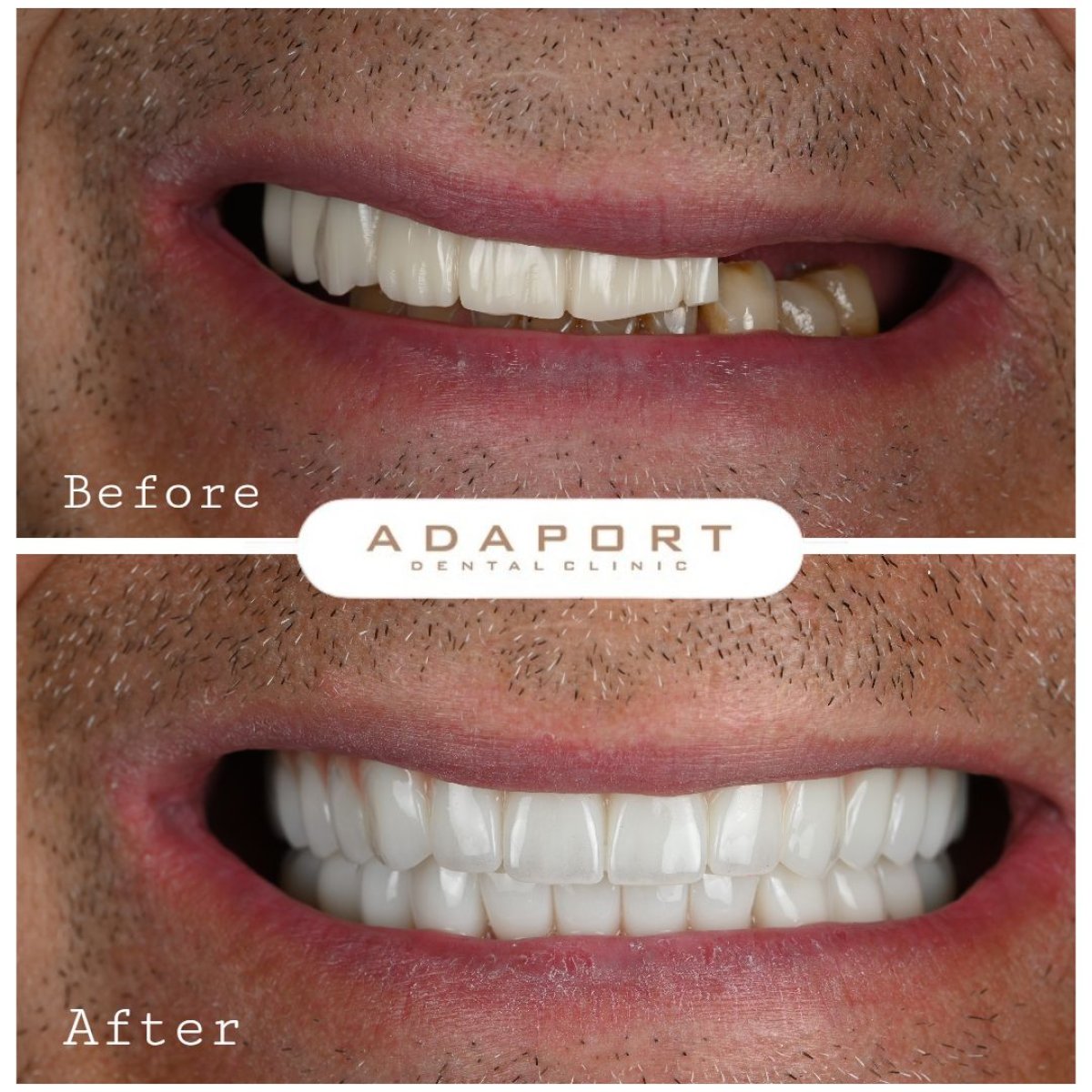 Résultat avant/après implants All-on-6 à Adaport Dental Clinic, restauration du sourire