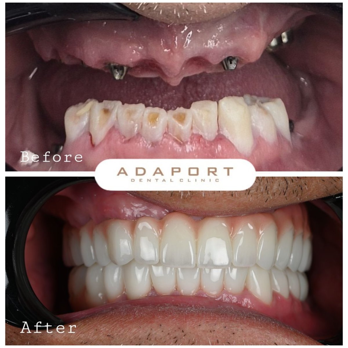 Résultat avant/après implants dentaires All-on-6 à Adaport Dental Clinic, sourire restauré