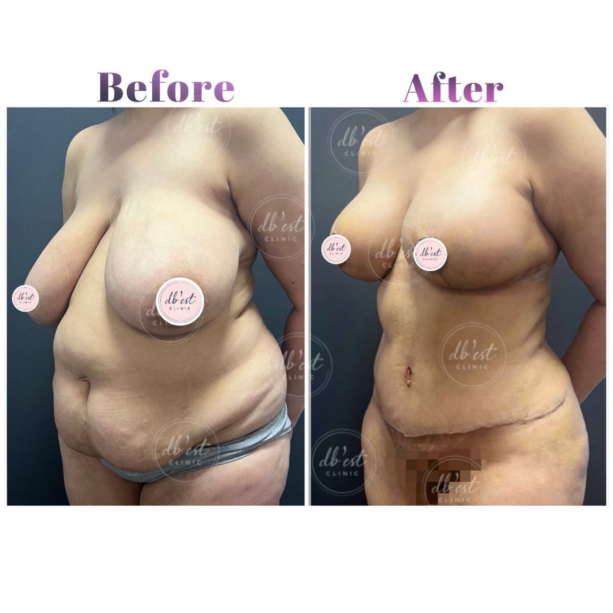 Resultados de lifting de senos y abdominoplastia antes y después en Db'est Clinic, mejor contorno