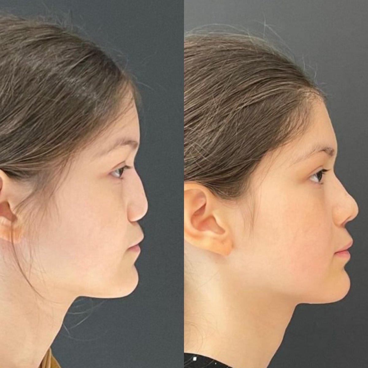 Resultados de rinoplastia antes y después en Medipol Acibadem District Hospital, remodelación nasal