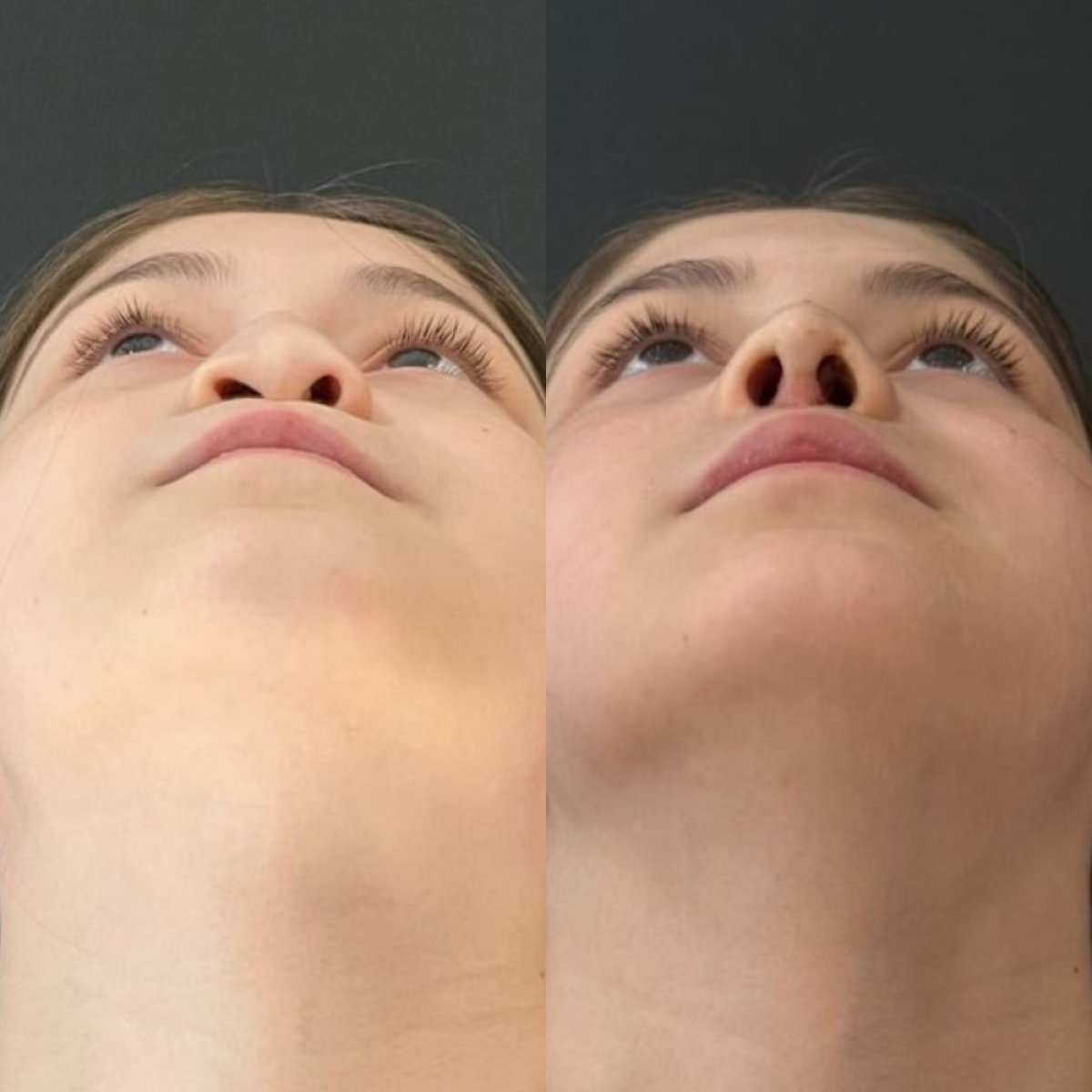 Résultats avant et après rhinoplastie à Medipol Acibadem District Hospital, remodelage du nez