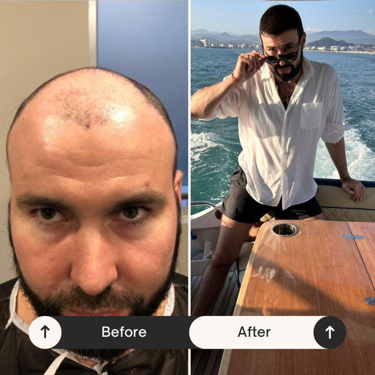 نتائج زراعة الشعر FUE قبل وبعد في Istanbul Hair Indonesia، استعادة خط الشعر