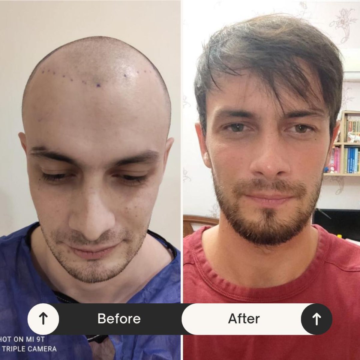 Vorher-nachher-Ergebnis FUE-Haartransplantation bei Istanbul Hair Indonesia, Haaransatz wiederhergestellt