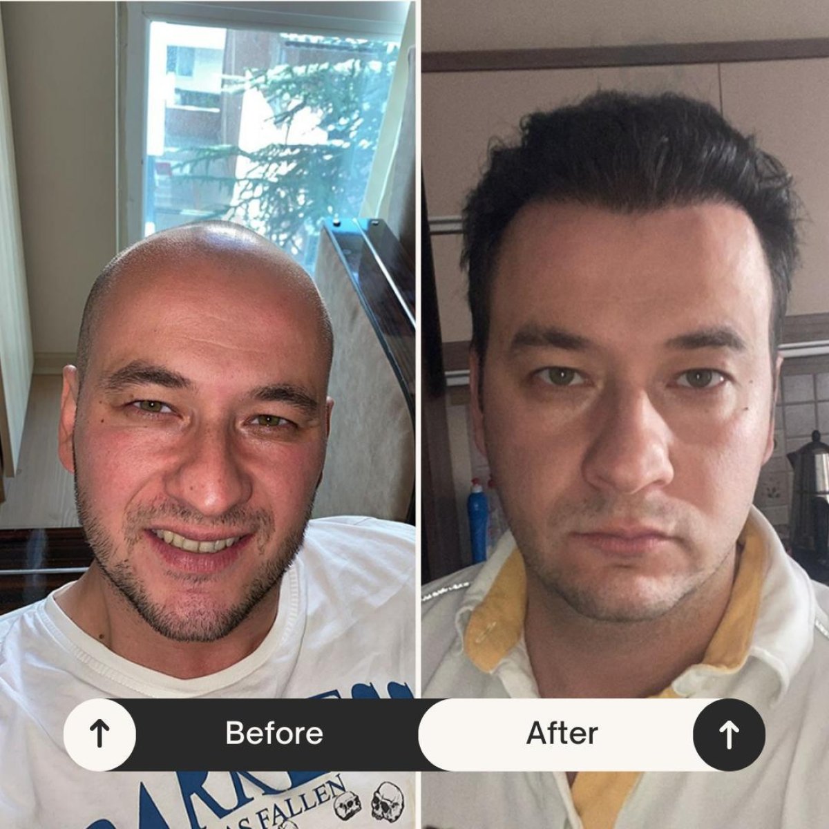 نتيجة قبل وبعد زراعة الشعر FUE في Istanbul Hair Indonesia، استعادة خط الشعر