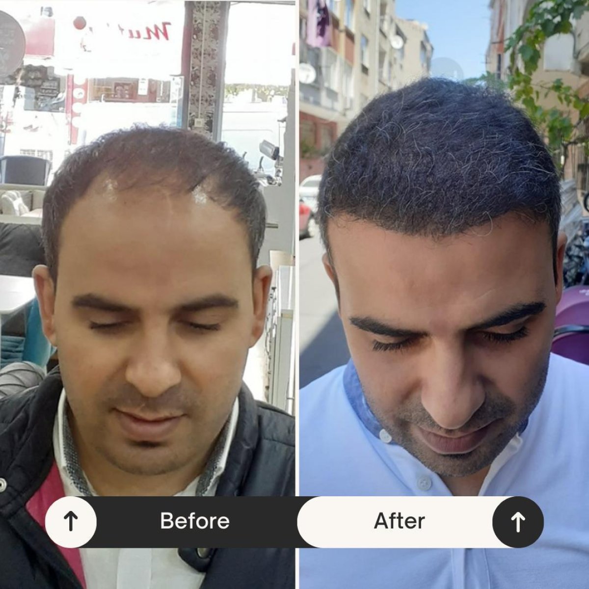 نتائج زراعة الشعر FUE قبل وبعد في Istanbul Hair Indonesia، استعادة خط الشعر