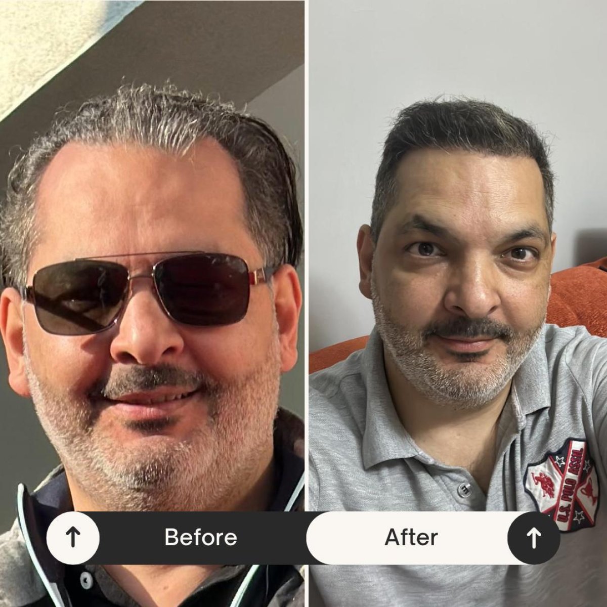 Resultados antes y después de trasplante capilar DHI en Istanbul Hair Indonesia, mayor densidad