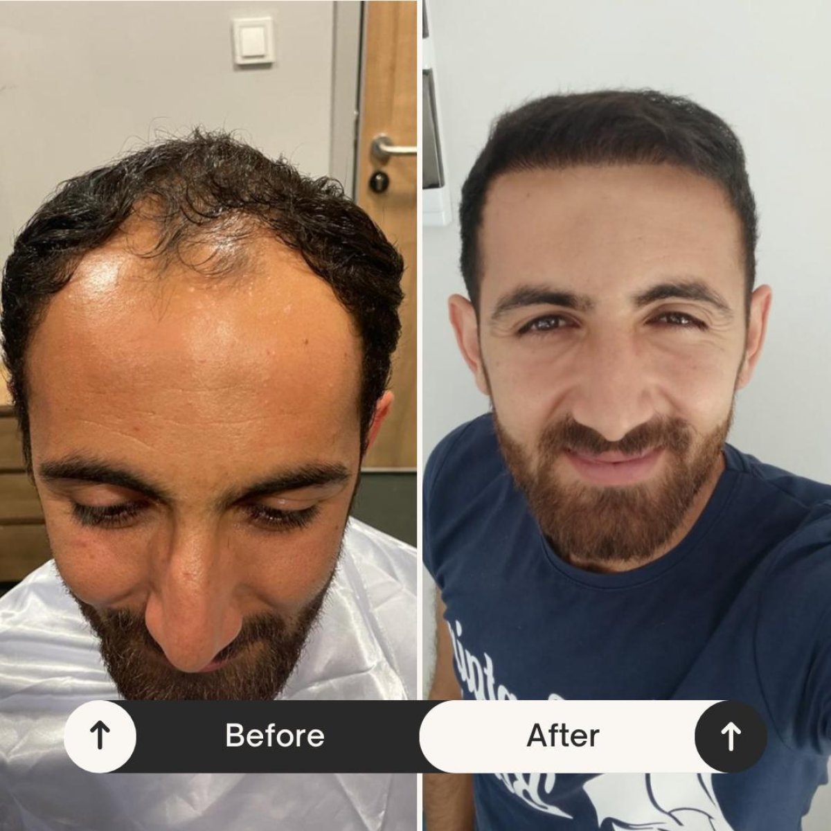 Resultados antes y después de trasplante capilar DHI en Istanbul Hair Indonesia, línea restaurada