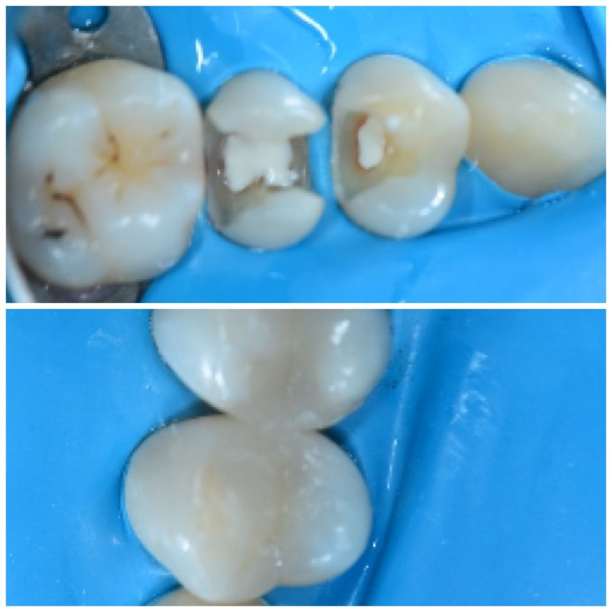 نتائج ترميم الأسنان (الترابط) قبل وبعد في Dentaland Premium Luxury Clinic & Academy