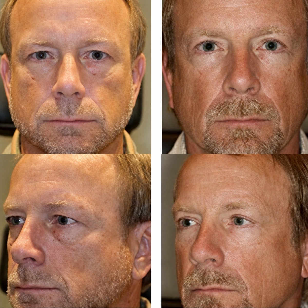 Resultados de blefaroplastia antes y después en Somchai Clinic, corrección de párpados masculina