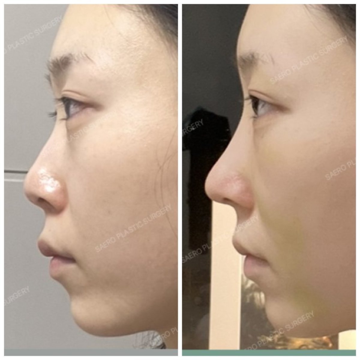 نتائج قبل وبعد تجميل طرف الأنف في SAERO Plastic Surgery، شكل أنف مصقول