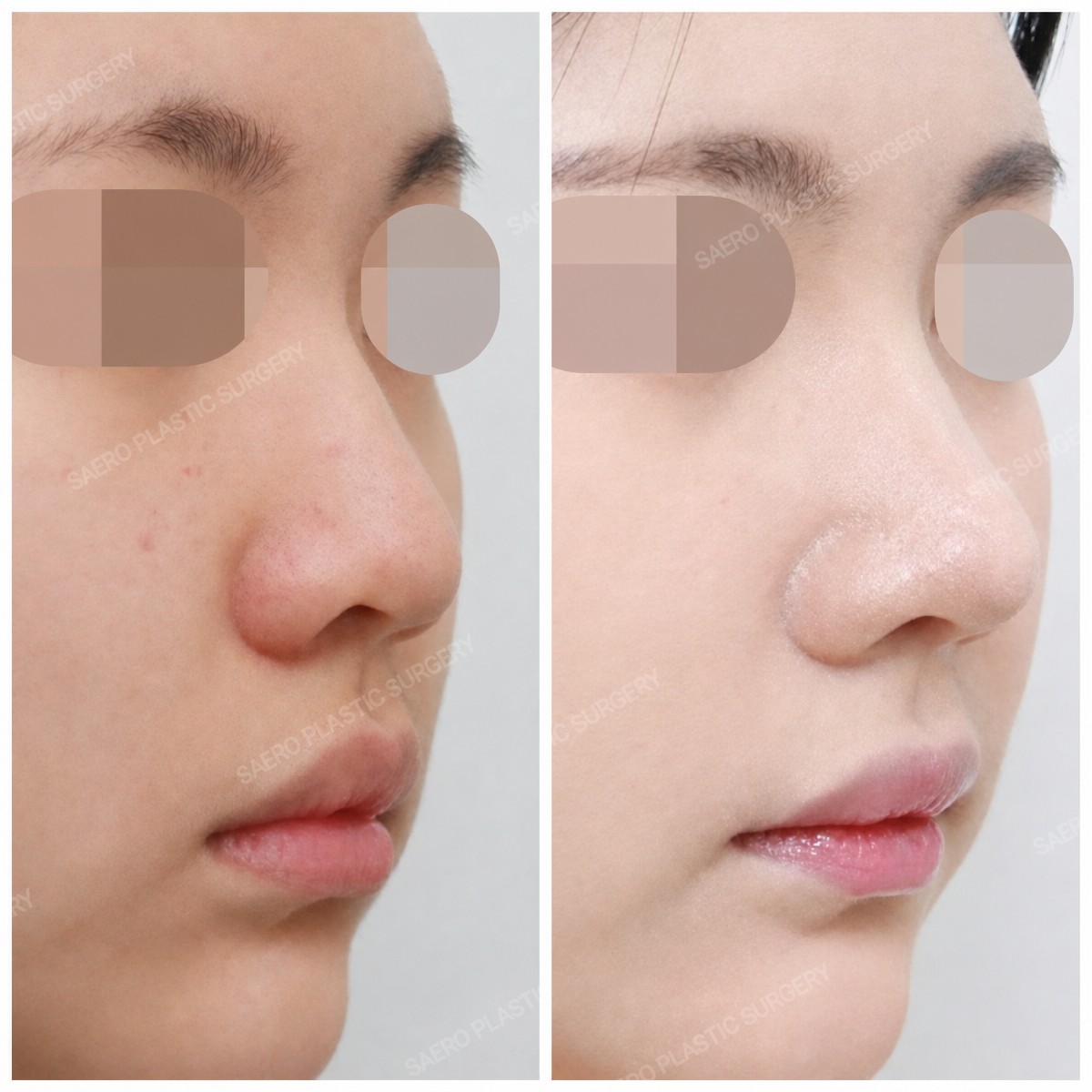 Efekty przed i po zamkniętej korekcji nosa w SAERO Plastic Surgery, poprawiony kształt nosa