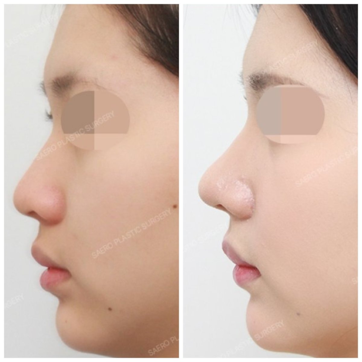 Результати до і після закритої ринопластики в SAERO Plastic Surgery, покращений профіль носа