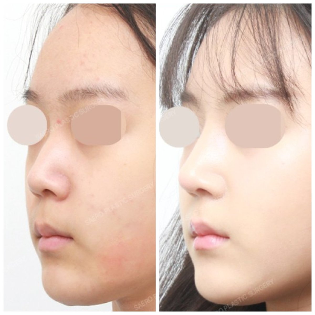 Closed rhinoplasty before and after results at SAERO Plastic Surgery, improved nose profile