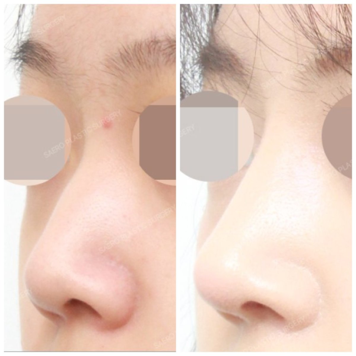 نتائج قبل وبعد عملية تجميل الأنف المغلقة في SAERO Plastic Surgery، تحسين شكل الأنف