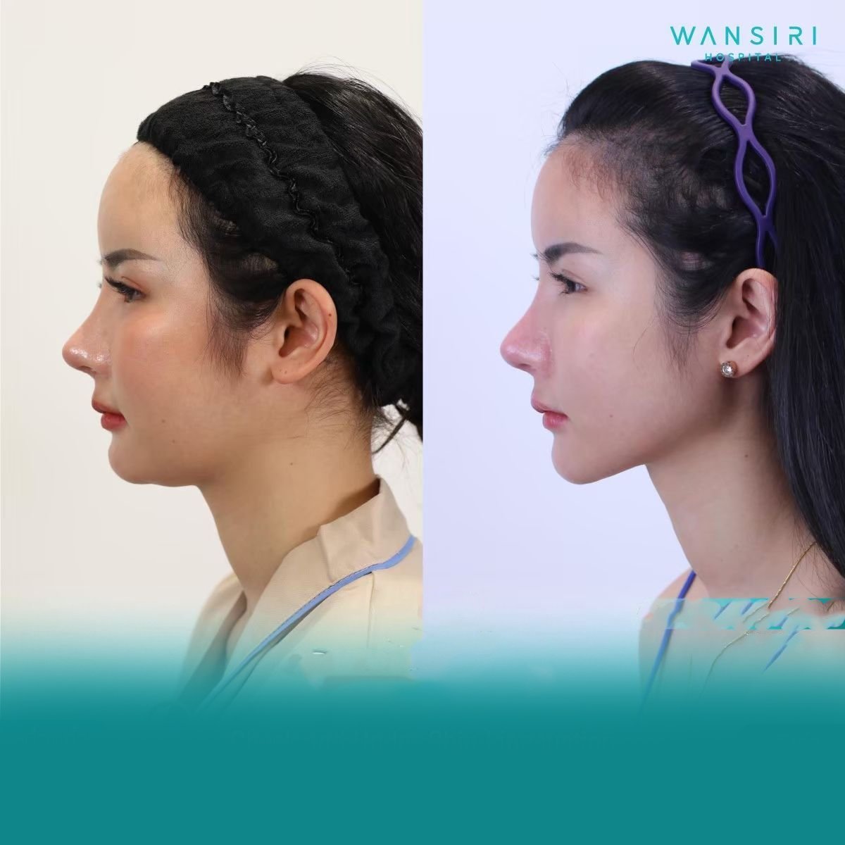 Before and after double chin liposuction results at Wansiri Hospital, improved jawline contour