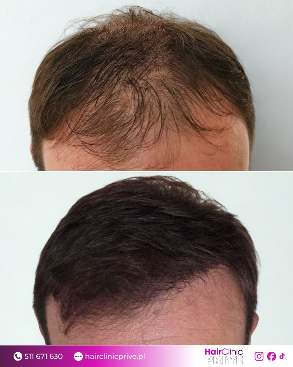 نتائج زراعة الشعر قبل وبعد في HairClinic Prive – استعادة خط وكثافة الشعر
