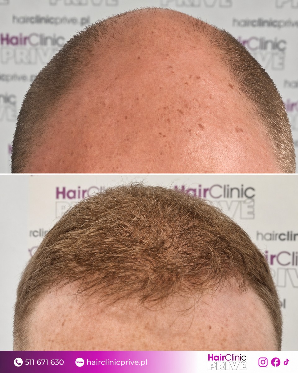 نتائج زراعة الشعر قبل وبعد في HairClinic Prive – استعادة خط وكثافة الشعر