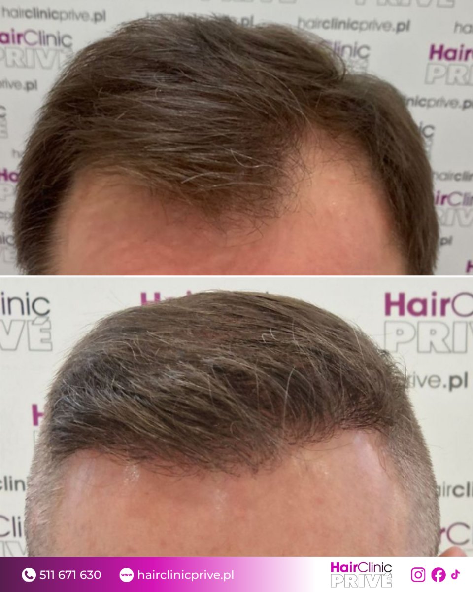 نتيجة زراعة الشعر قبل وبعد في HairClinic Prive – كثافة خط الشعر المحسّنة