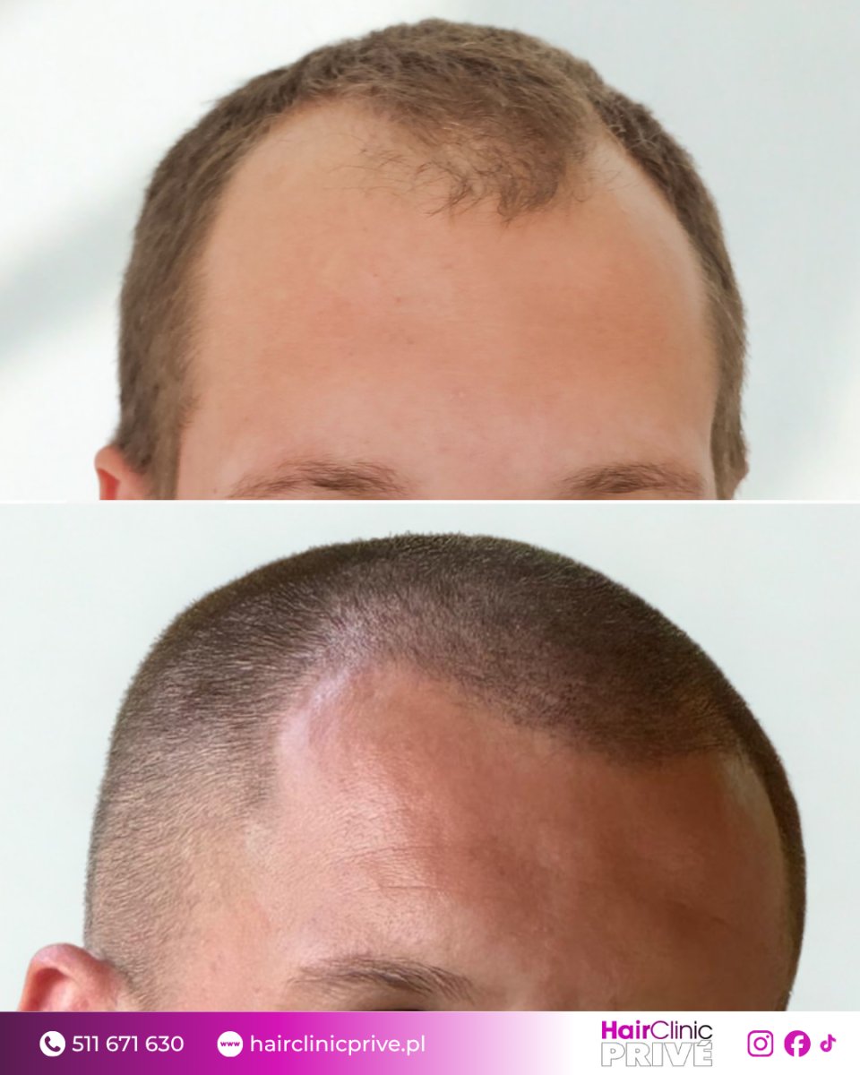 نتيجة زراعة الشعر قبل وبعد في HairClinic Prive – استعادة خط الشعر لدى المريض