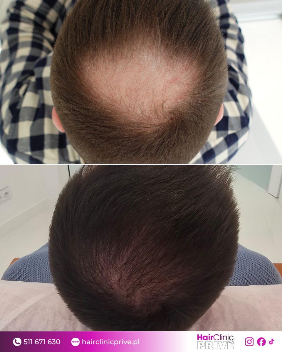 نتيجة زراعة الشعر قبل وبعد في Hair Clinic Prive – كثافة محسنة في التاج