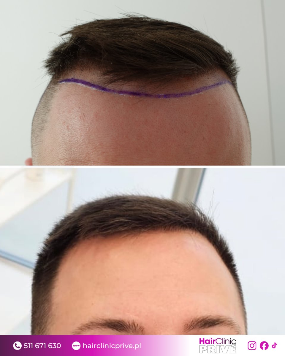 نتائج زراعة الشعر قبل وبعد في Hair Clinic Prive – استعادة خط الشعر الطبيعي