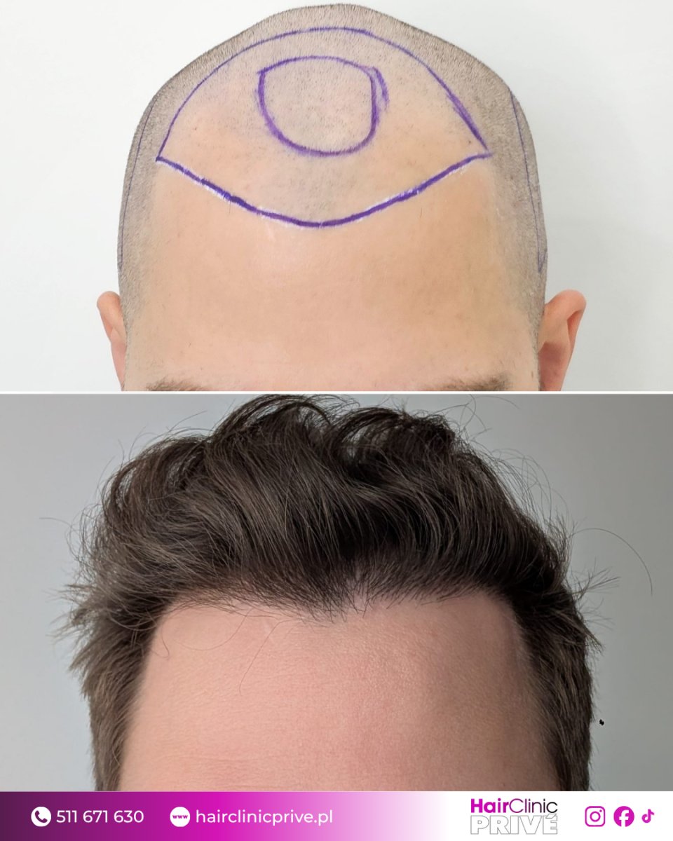 نتيجة زراعة الشعر قبل وبعد في Hair Clinic Prive – استعادة خط الشعر الطبيعي
