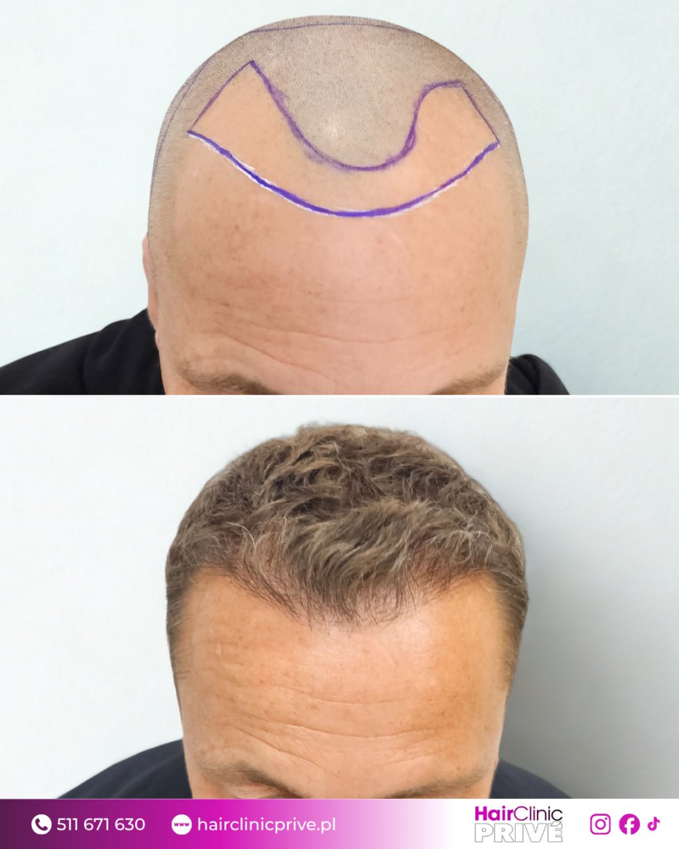 نتيجة زراعة الشعر قبل وبعد في Hair Clinic Prive – استعادة خط الشعر الطبيعي