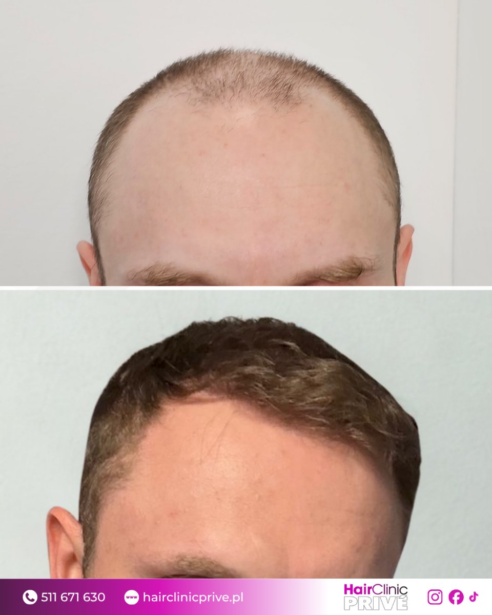 Resultado de trasplante capilar antes y después en HairClinic Prive – línea capilar restaurada