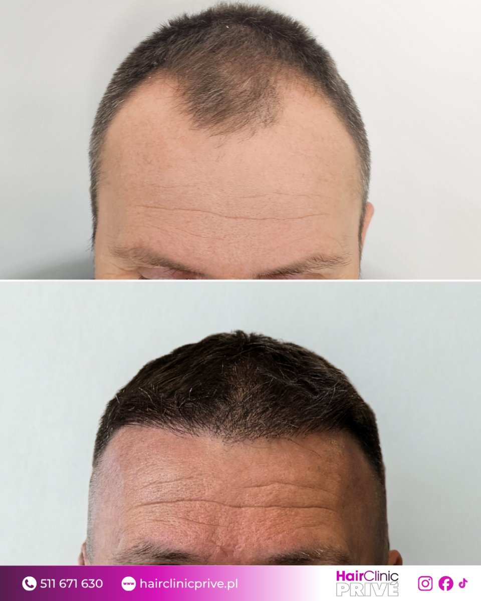 نتائج زراعة الشعر قبل وبعد في HairClinic Prive – استعادة خط الشعر الممتلئ