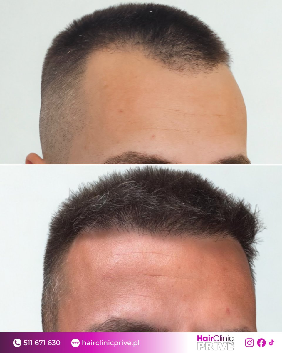 نتائج زراعة الشعر قبل وبعد في HairClinic Prive – استعادة خط الشعر الممتلئ