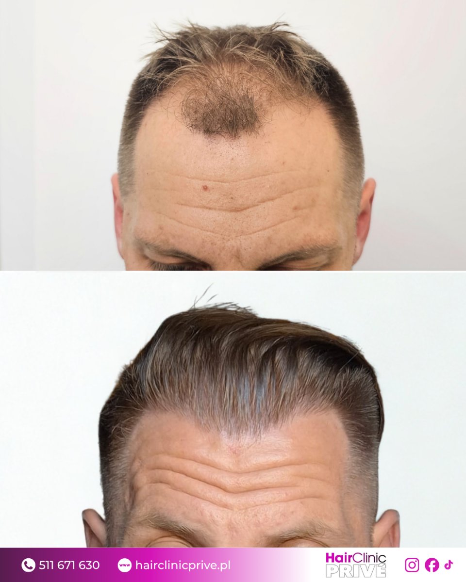 نتيجة زراعة الشعر قبل وبعد في Hair Clinic Prive – استعادة خط الشعر الممتلئ