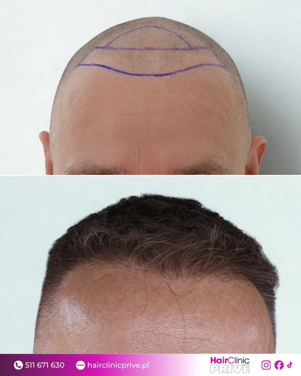 Resultados de trasplante capilar antes y después en Hair Clinic Prive – línea natural restaurada