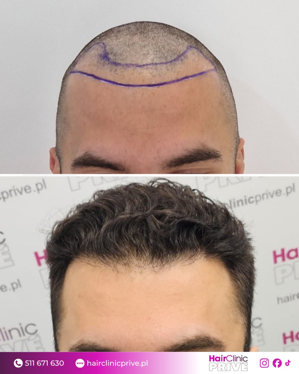 نتيجة زراعة الشعر FUE قبل وبعد في HairClinic Prive – استعادة خط الشعر